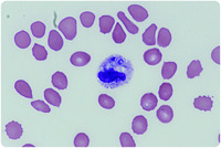 Disseminated histoplasmosis in peripheral blood smear