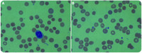 Anemia and thrombocytopenia: diagnosis from the blood smear