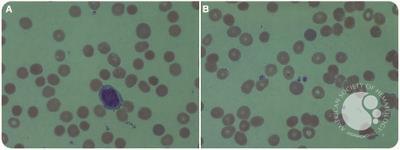 Anemia and thrombocytopenia: diagnosis from the blood smear