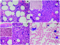 Progression of romiplostim myelofibrosis to myeloproliferative neoplasm