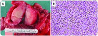 Enteropathy-associated T-cell lymphoma, type II (monomorphic variant)