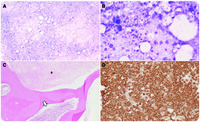 Bone marrow necrosis in de novo AML