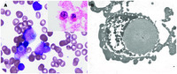 “Russell-like” bodies in Philadelphia chromosome–positive B-lymphoblastic leukemia