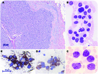 Aggressive bone marrow metastatic medullary thyroid carcinoma