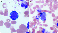 Sideroblastic anemia secondary to zinc toxicity
