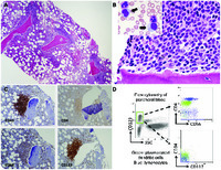 Plasmacytoid dendritic cells in chronic myelomonocytic leukemia