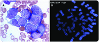 Acute myeloid leukemia pretreated with filgastrim mimicking acute promyelocytic leukemia