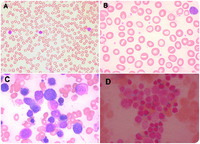 Refractory anemia with ring sideroblasts associated with thrombocytosis (RARS-T)