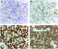 Graft-versus-leukemia in the bone marrow