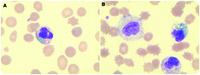 Green neutrophilic inclusions could be a sign of impending death!