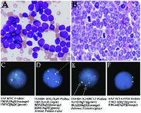 A leukemic presentation of a “triple-hit” lymphoma