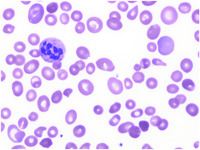 Severe vitamin B12 deficiency mimicking thrombotic thrombocytopenic purpura