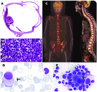 Uveal melanoma with diffuse bone marrow involvement