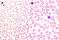 Functional hyposplenism diagnosed by blood film examination