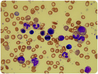 Parvovirus infection mimicking a myeloproliferative neoplasm in a toddler with sickle cell disease