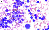 Basophilic blast phase of chronic myelogenous leukemia