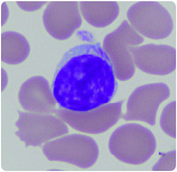 Lymphoproliferative disorder with Auer rod–like inclusions