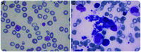 Childhood myelodysplastic syndrome associated with an acquired Bernard-Soulier–like platelet dysfunction