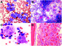 Histiocytic clearance of neoplastic cells in acute promyelocytic leukemia