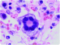 Blasts with rosette-like multinucleation in acute myeloid leukemia with complex cytogenetic abnormalities