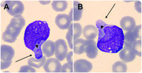 Magic mirror in my hand, which is the lineage in the end? A case of acute leukemia with hand-mirror cells