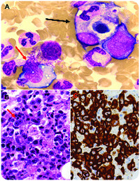 Hemophagocytosis due to bone marrow ALCL, ALK–