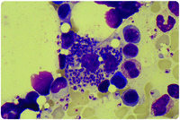 Unexpected bone marrow finding in a patient with pancytopenia after hematopoietic stem cell transplantation