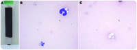 Massive hemolysis and erythrophagocytosis in severe sepsis