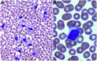 Abnormal lymphocytes with “filamentous-like” cytoplasmic inclusions in