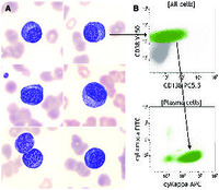 An unusual posttransplant EBV-associated lymphoproliferative disorder exhibiting plasmacytic features in leukemic phase