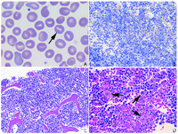 Dehydrated hereditary stomatocytosis masquerading as MDS