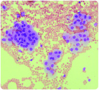 Ependymal Cells In Cerebrospinal Fluid A Traumatic Occurrence