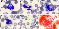 Diagnosis of bacteremia on a blood smear