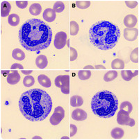 Howell-Jolly–like bodies in neutrophils