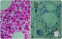 Parvovirus B19 diagnosed by bone marrow biopsy