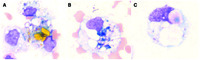 Indicators of true intracerebral hemorrhage: hematoidin, siderophage, and erythrophage