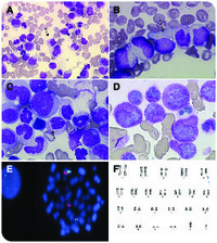 Misleading acute promyelocytic leukemia morphology