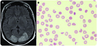 Simultaneous PRES and TMA secondary to tacrolimus after allogeneic bone marrow transplant