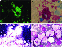 Countless mycobacteria inside a macrophage