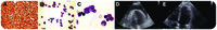 Mantle cell lymphoma presenting as cardiac tamponade