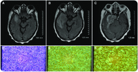 Rapid evolution of intracranial myeloid sarcoma in 4 weeks: images in blood