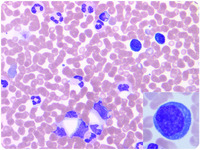 Diagnosis of hantavirus cardiopulmonary syndrome with peripheral blood film