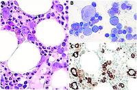 Acute parvovirus B19 infection detected in bone marrow biopsy