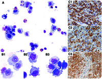 Cellular morphology of BRAF V600E-positive Langerhans cell histiocytosis