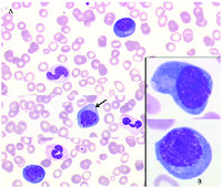 Leukemic phase of a large B-cell lymphoma arising in KSHV-associated multicentric Castleman disease