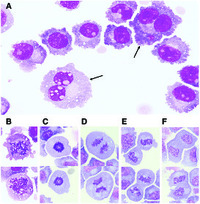 malignant cells in csf