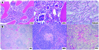 TAFRO syndrome or Castleman-Kojima syndrome: a variant of multicentric Castleman disease