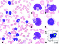 Pleomorphic plasma cell leukemia