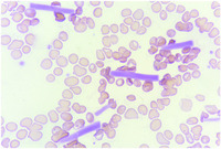 Cryoglobulinemia presenting with crystals in peripheral blood