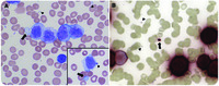 Pseudoplatelets in acute myeloid leukemia